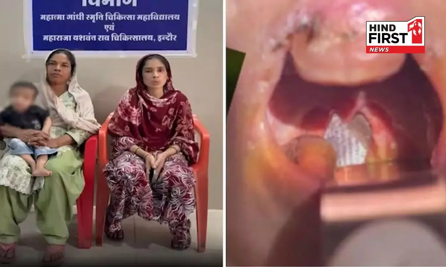 Indore: Fish Lodged in One-Year-Old’s Throat; Swallowed While Playing—Doctors Save Life Through Surgery Indore: Fish Lodged in One-Year-Old’s Throat; Swallowed While Playing—Doctors Save Life Through Surgery