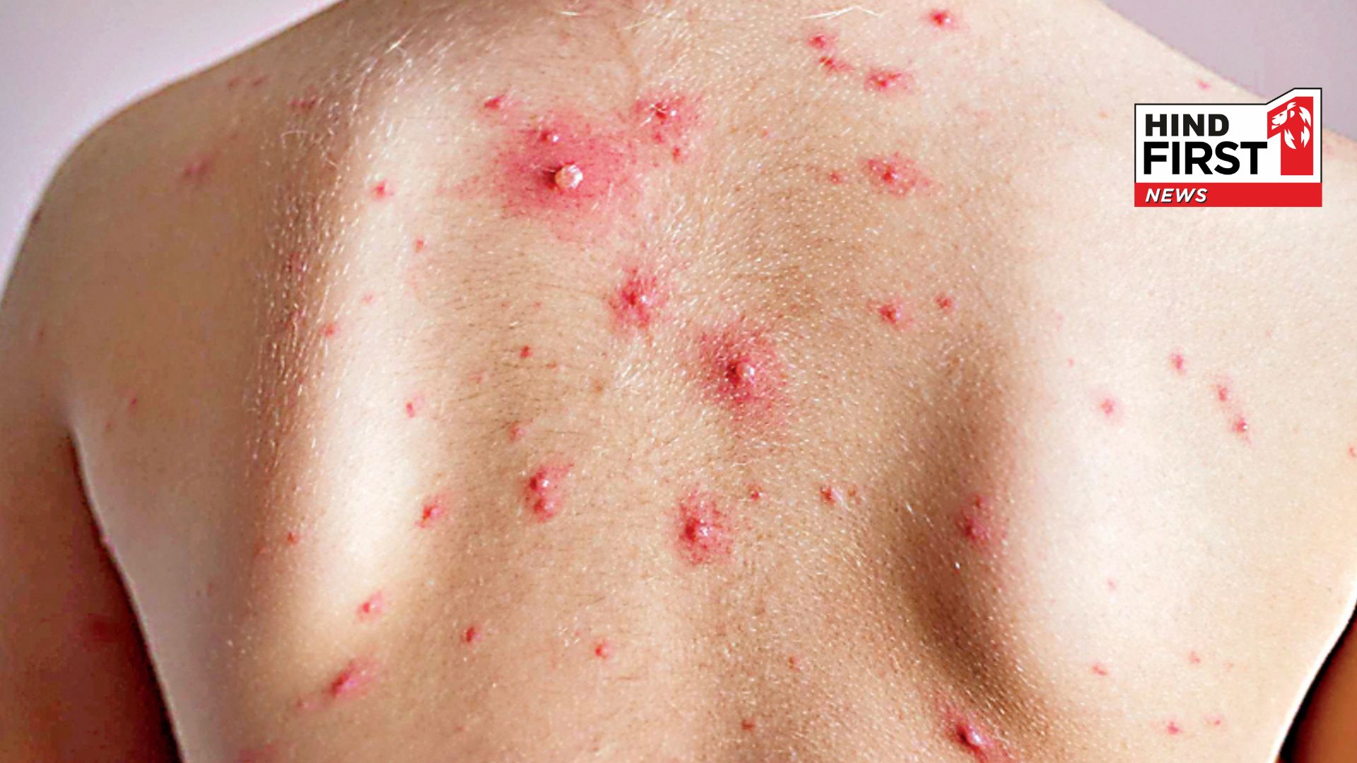 Monkeypox virus in India: A suspected patient found, now he is in isolation, health Ministry issued adviser for travelers