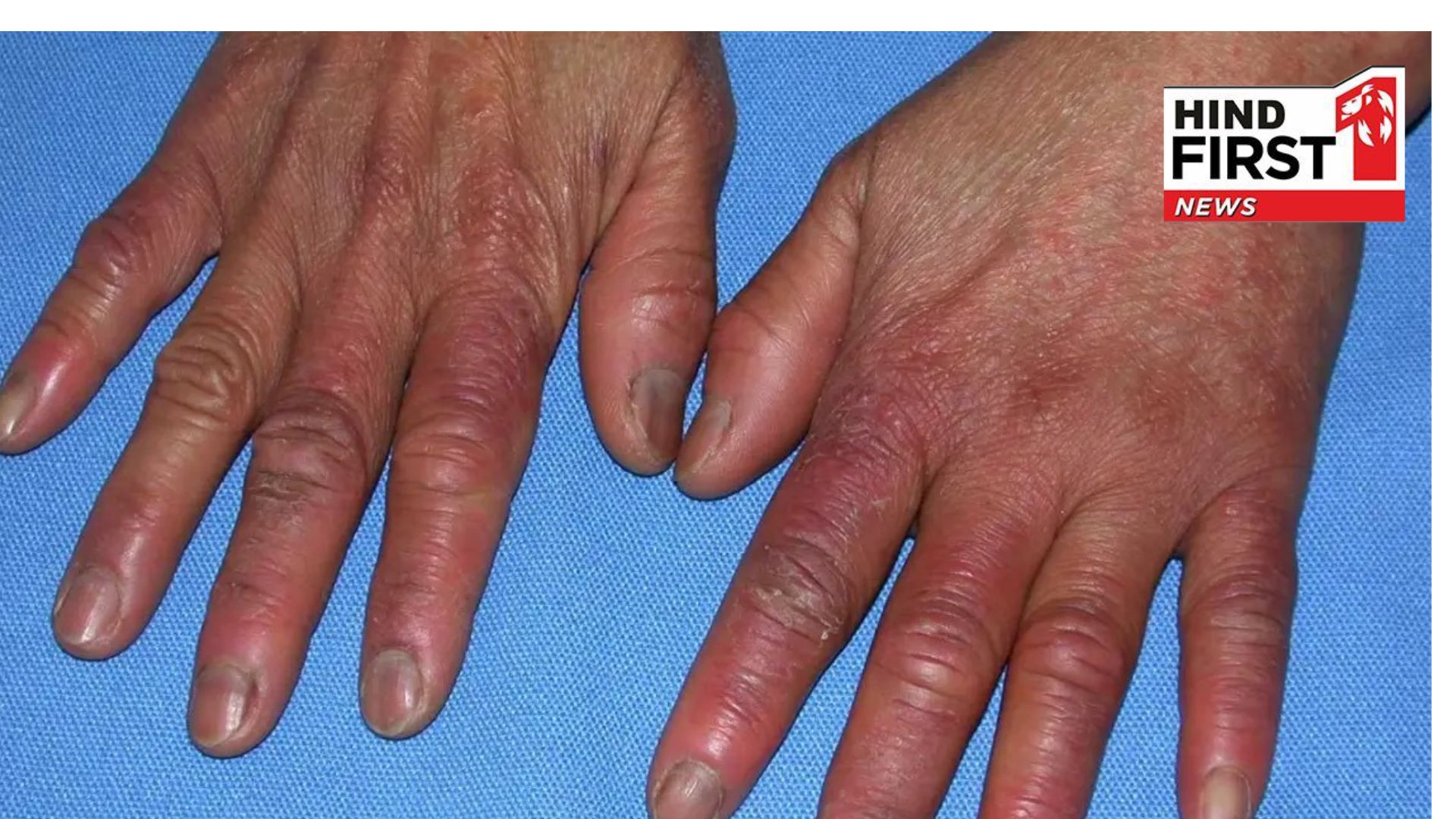 Prevent Swollen Fingers and Toes in the Cold: Take Care Now Prevent Swollen Fingers and Toes in the Cold: Take Care Now