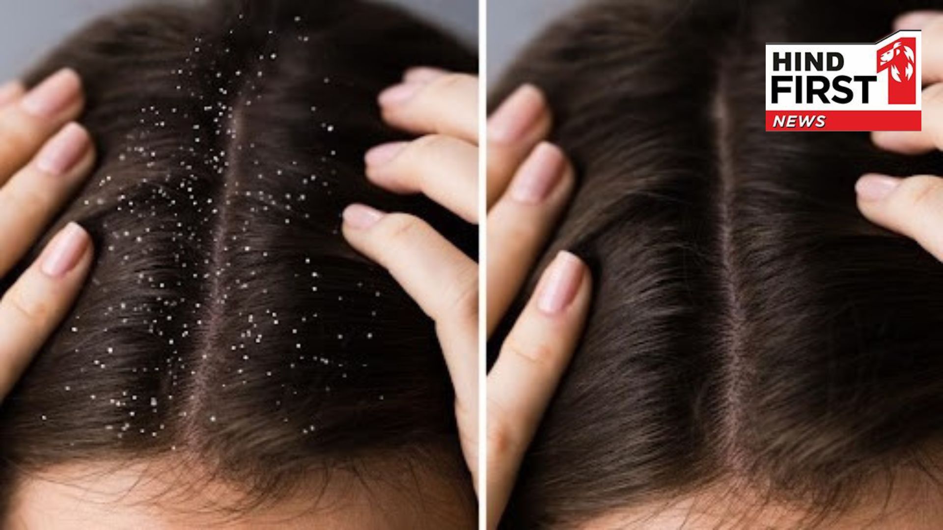 Try these four home remedies to remove dandruff from your scalp Try these four home remedies to remove dandruff from your scalp